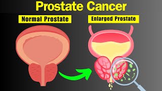 The Silent Threat: Prostate Cancer Explained