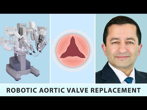 Robotic Aortic Valve Replacement: A Heart Valve Innovation with Dr. Vinay Badhwar