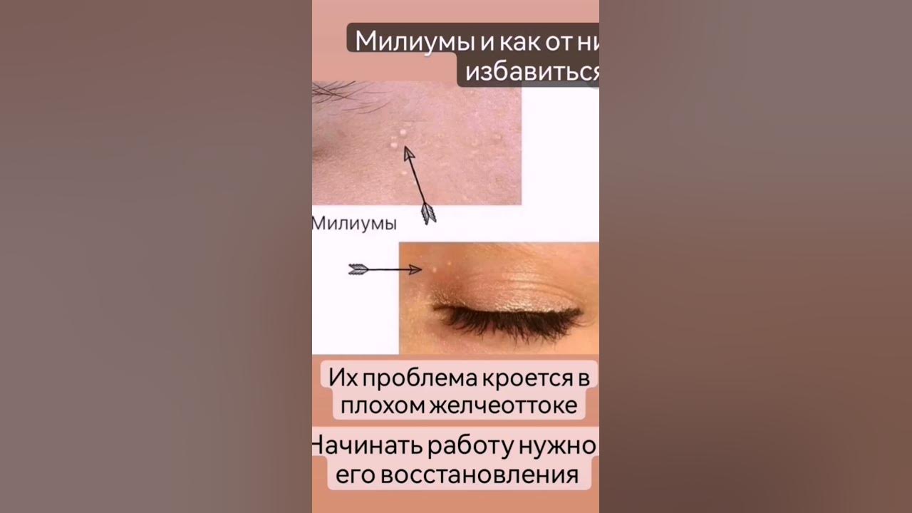 милиумы и как их убрать, подробнее в комментарии - YouTube