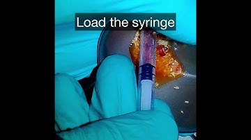 Extraction of Incisor with Socket Preservation Using Fibrin Membrane