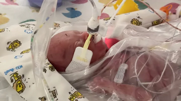 Born a Micro-Preemie | Hope For Our Tiniest and Most Fragile Patients