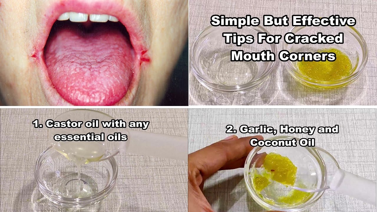 Simple But Effective Tips For Cracked Mouth Corner Angular Cheilitis