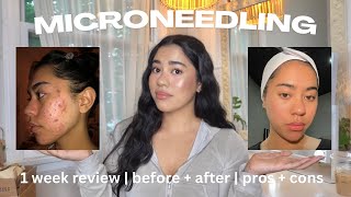 Is MICRONEEDLING worth it? | 1 week before + after *REVIEW*