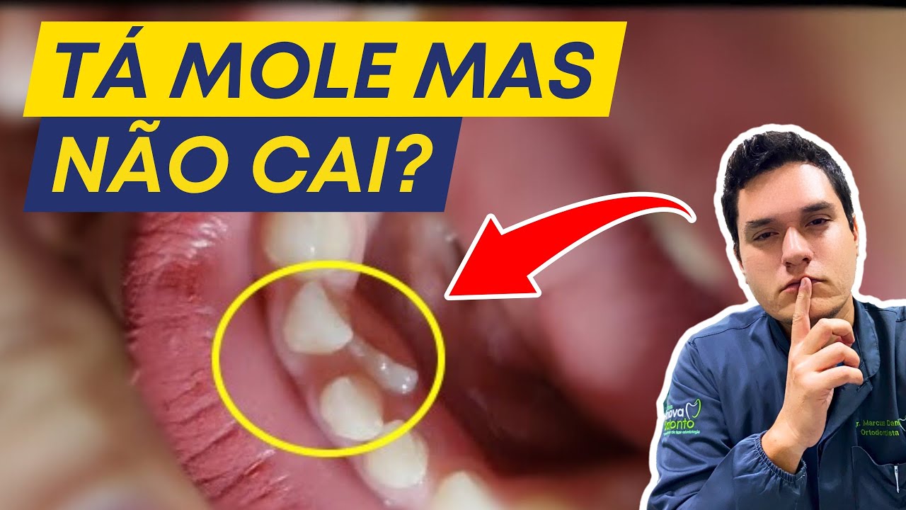 DENTE DE LEITE MOLE MAS NÃO CAI: O QUE FAZER? - YouTube