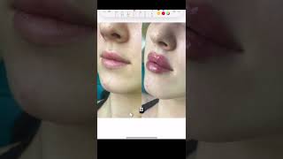 Разбор ошибок при коррекции губ #filler #контурнаяпластикагуб