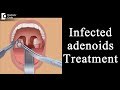 Treatment of infected adenoids in children - Dr. Satish Babu K