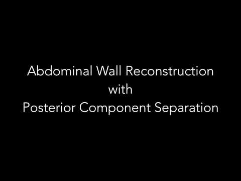Abdominal Wall Reconstruction with Posterior Component Separation technique, TAR and BioA implant
