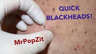 Quick and easy blackhead extractions!! Imbedded plugs removed with ease! screenshot 1