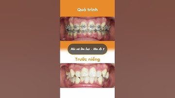 Hành trình LỘT XÁC nhờ niềng răng của Anh Thư