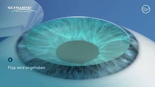 SmartLasik (Femto-LASIK)