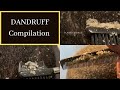 Dandruff compilation