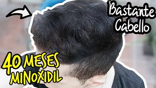 MINOXIDIL 40 Meses RESULTADOS en el Cuero Cabelludo para CAIDA DE CABELLO | Tratamiento Calvicie