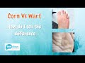 Corn Vs Wart - How Do I Tell The Difference