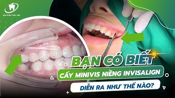 NIỀNG RĂNG INVISALIGN CÓ CẦN CẮM MINIVIS? CÙNG TÌM HIỂU TRONG VIDEO NÀY NHÉ!