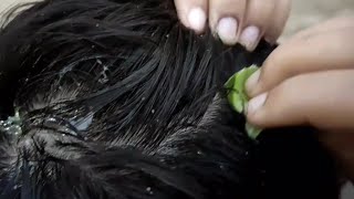 aloe vera gel for hair | dandruff treatment at home | bal se dandruff kaise hataye screenshot 3