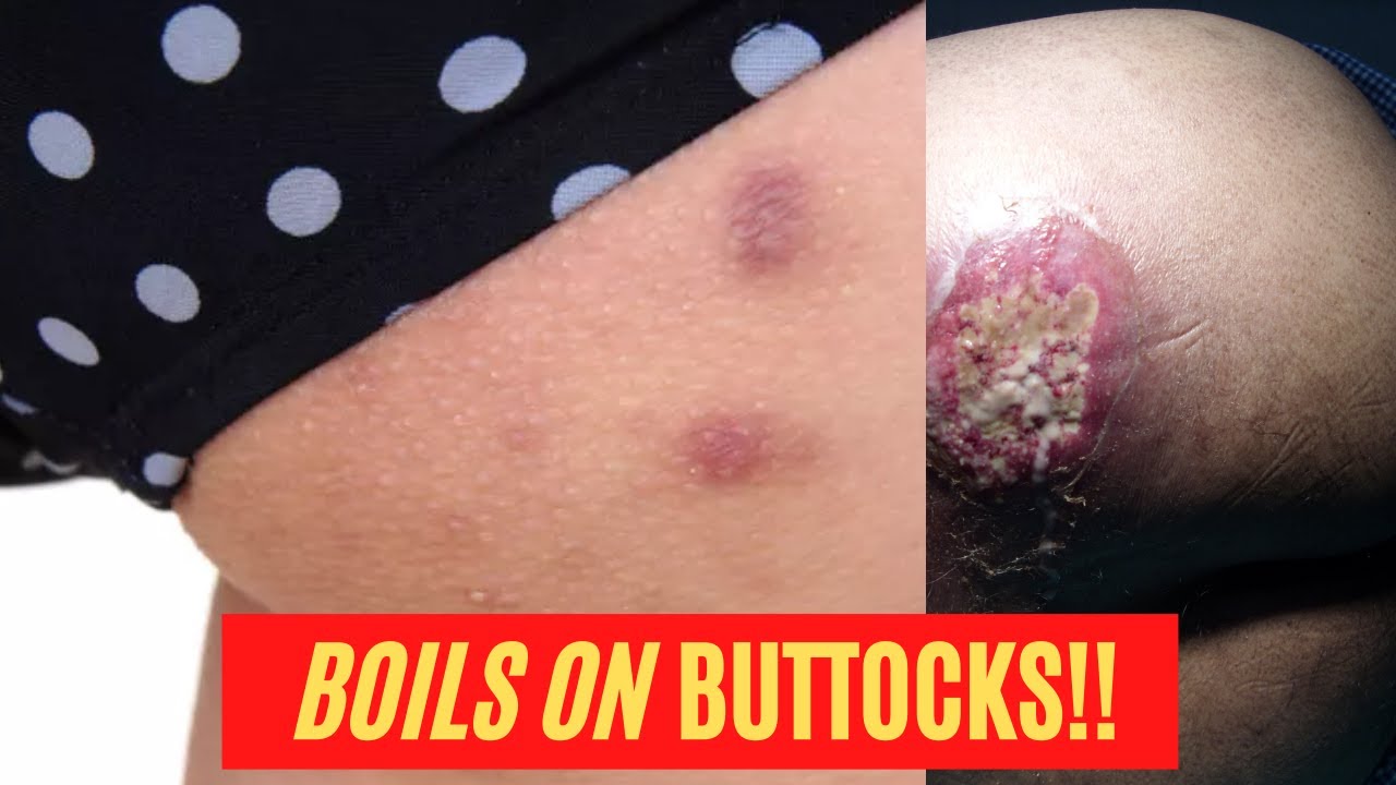 The 7 Most Effective Home Remedies For Boils On Buttocks Boils