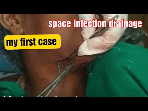 Submandibular & submental space infection surgery video ||incision &drainage||odontogenic infection