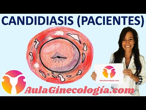 NOTICIA-TODOS LOS MESES CANDIDIASIS - ROCIO CARRASCO GINECOLOGA EN MALAGA, GINECOLOGO EN MALAGA