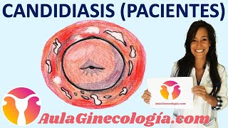 CANDIDIASIS VAGINAL (PACIENTES): Causas, síntomas, tratamiento  - Ginecología y Obstetricia -