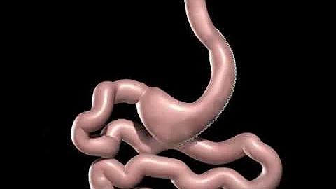 Gastric Sleeve Animation