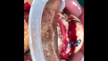 Mortise Tenon Genioplasty for Obstructive Sleep Apnea