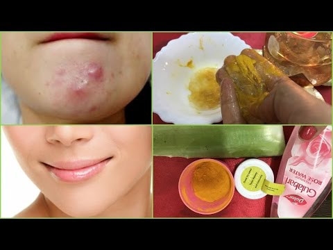 Aloe Vera Miracle Gel Face pack for Overnight Acne Treatment|Best Way to get Clear Face Skin :)