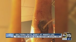Bacteria eats away Arizona man's leg
