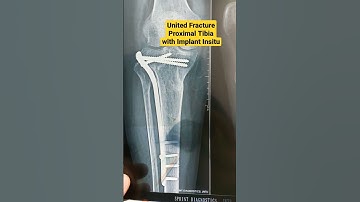 United Fracture Proximal Tibia with Implant Insitu..Dr Sai Chandra. Trauma, Joint Replacement..