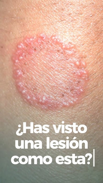 ¡Descubre cómo identificar las tiñas de manera efectiva!🔬💊 #Tiñas # ...