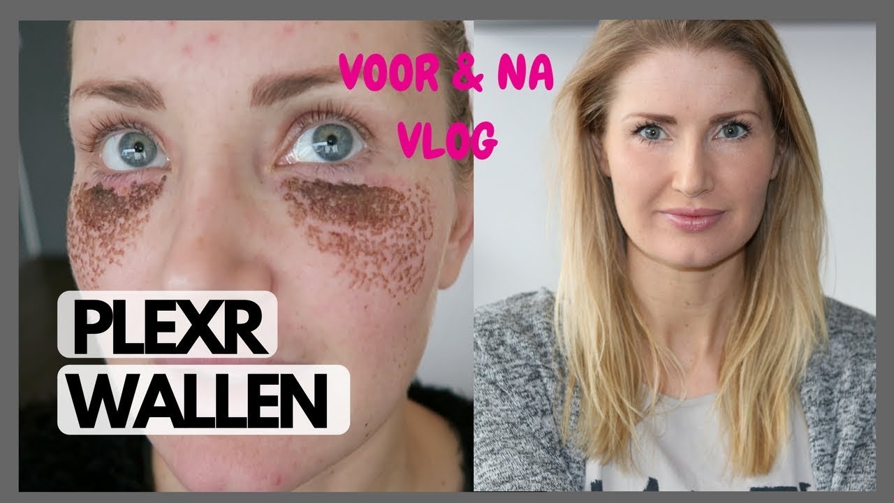 PlexR behandeling onderkant ogen/ wallen - #DIESDOET diesnaloomans.nl