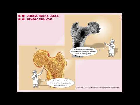 Video: Individualizovaná Léčba Denosumabem U Dětí S Osteogenezní Imperfectou - Sledování Pokusné Skupiny
