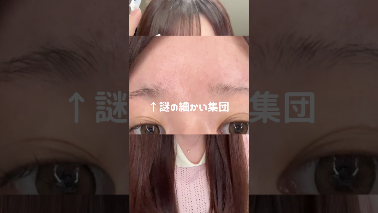【おでこのプツプツ】1個ドーンじゃなくて、細かいのがずっと居る..。同じ悩みの子に届け！！！# PR #ブラン #Blanc #マジックドクダミ化粧水 #ニキビ