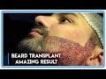 Fue surgery beard transplant amazing results beforeafter