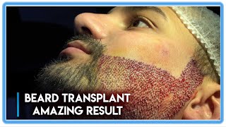 FUE Surgery: Beard Transplant Amazing Results [Before-After]
