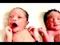 A Just Born First Attempt Success IVF Twins of Bhuvanagiri Couple at Dr Padmaja IVF Hyderabad