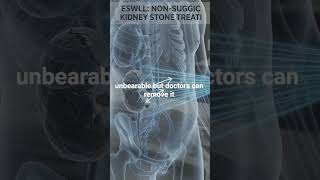 Kidney Stone Treatment Without a Single Cut | ESWL Explained