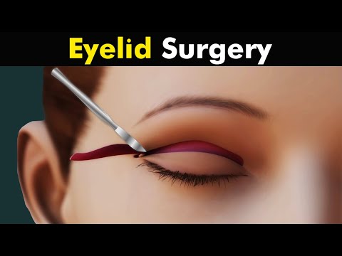 How Blepharoplasty is performed? Eyelid surgery Animation