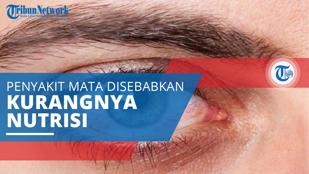 Mengenal Xerophthalmia, Penyakit Mata yang Bisa Sebabkan Kebutaan