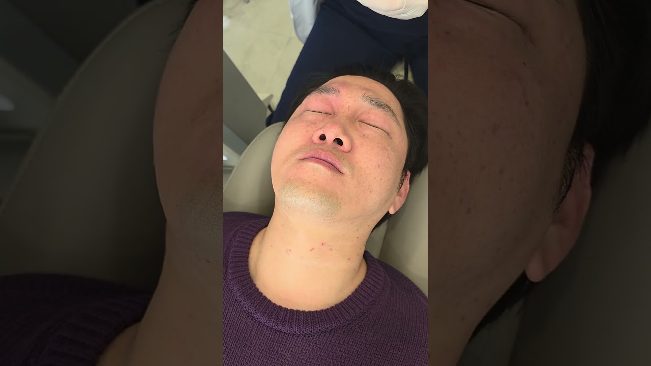눈꺼풀 사마귀 제거→ Eyelid Wart Removal #스킨케어 #skincare #kbeauty