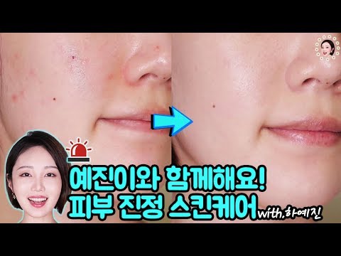 [<strong>eng</strong>]예진이와 뒤집어진 피부 <strong>3일</strong> 복구 프로젝트!👍👍👍