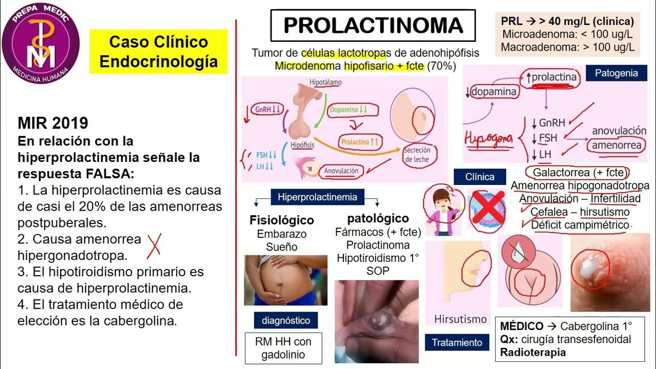 PROLACTINOMA - CASO CLÍNICO // PREPAMEDIC - YouTube