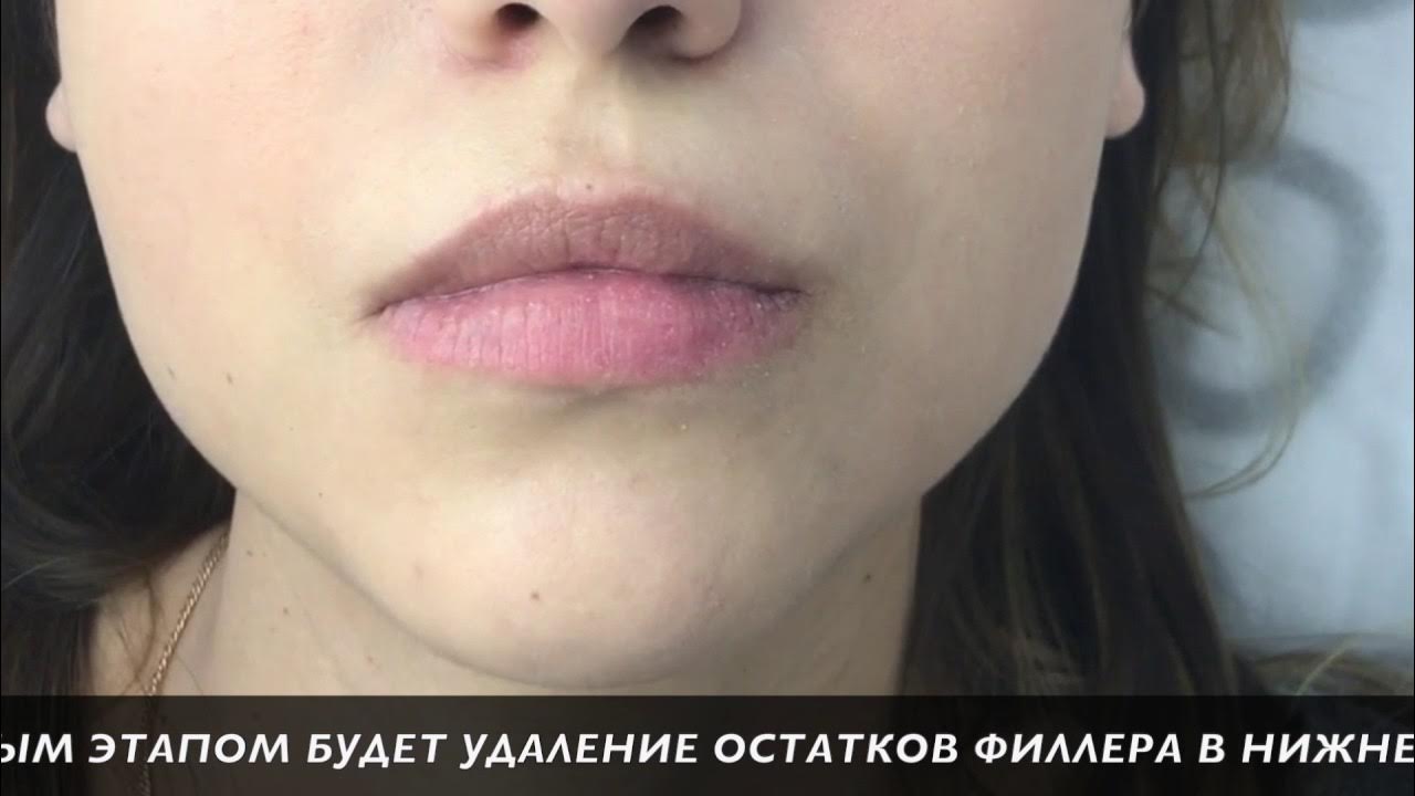 Фиброз губ после филлера как выглядит Удаление геля из губ. ГИАЛУРОНИДАЗА. ЛИДАЗА. - YouTube