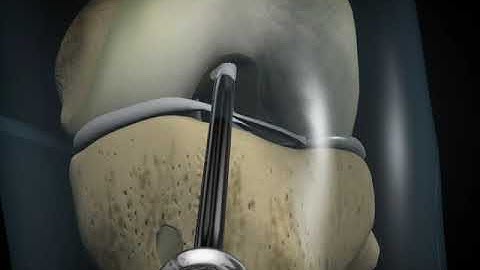 ACL Knee Surgery Part 2 | Educational Video | Dr. Ashutosh Ajri