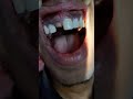 zirconia crown# tooth # smile makeover# shanti dental