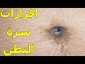 افرازات سرة البطن أسباب وعلاج 
