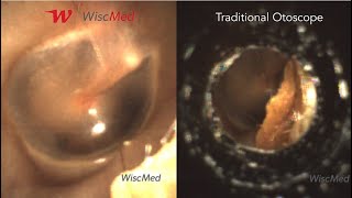Wispr Digital Otoscope Vs Traditional Otoscope