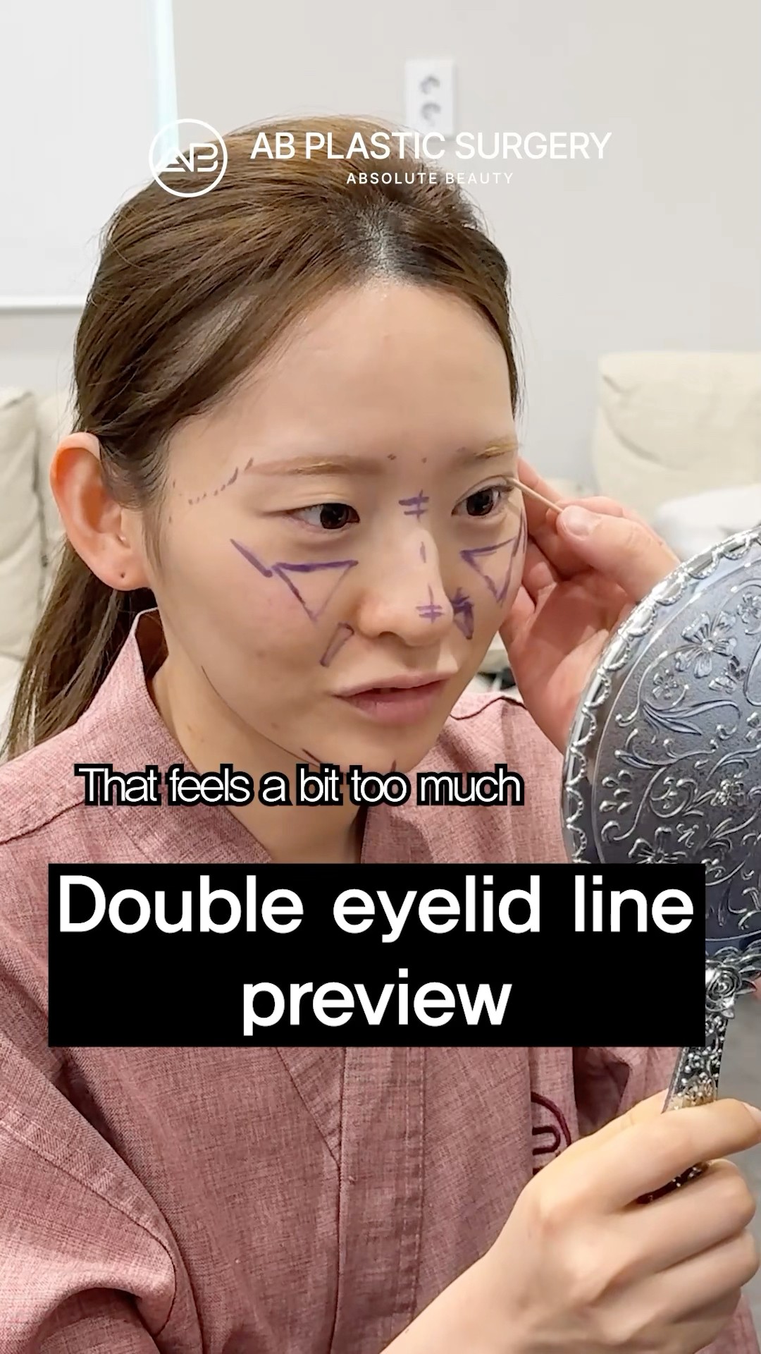 before and after double eyelid surgery revision #koreanplasticsurgery