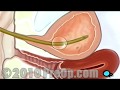 PostCare患者教育を伴う膀胱鏡検査の女性の膣