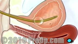 PostCare患者教育を伴う膀胱鏡検査の女性の膣