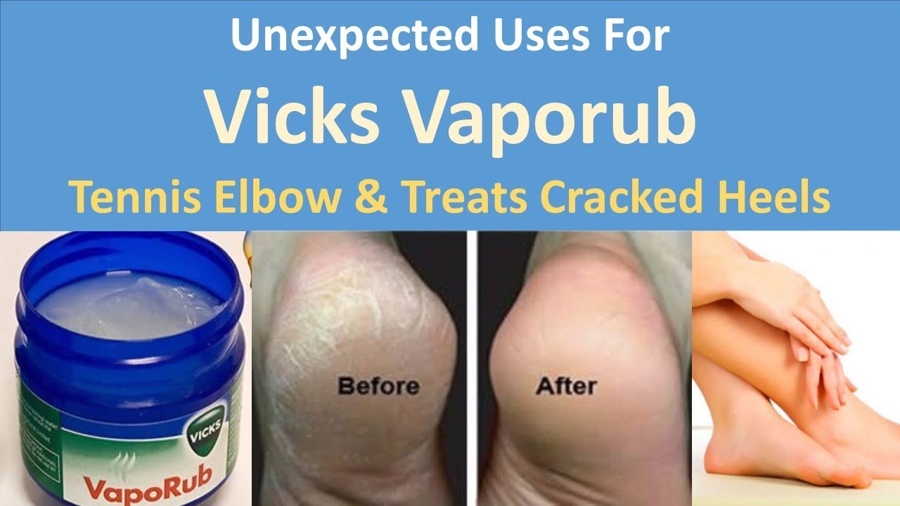 vicks on feet for cracked heels